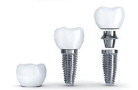 Diagram of different types of dental implants in Woodbridge