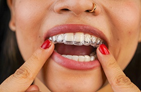 Close-up of woman’s mouth as she places Invisalign on her teeth