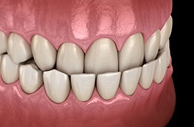 Digital image of an underbite viewed against dark background