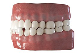 3D illustration of a crossbite