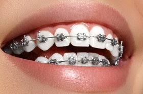 Traditional Braces Santa Rosa CA, Wiseman & Skabelund Dentistry
