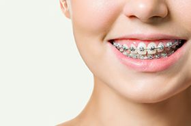 Close-up of woman’s smile with traditional braces in Woodbridge