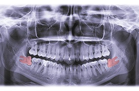 X-ray showing two impacted wisdom teeth