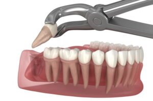 Illustration of forceps removing a wisdom tooth